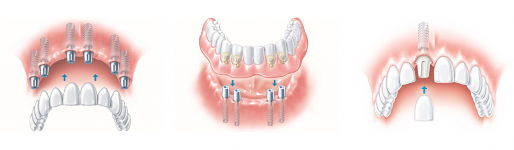 technical image representing tooth implants installation