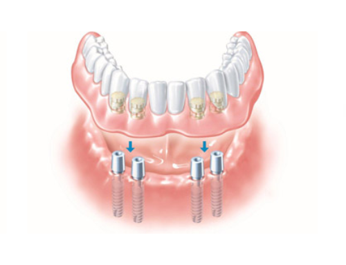 Dental implants – New Teeth, New You